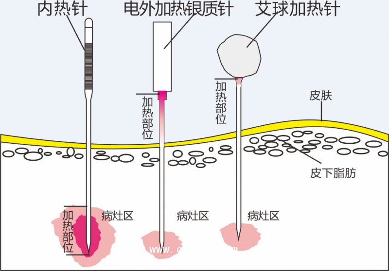 內(nèi)熱針治療儀50D 新款百士康誠招代理