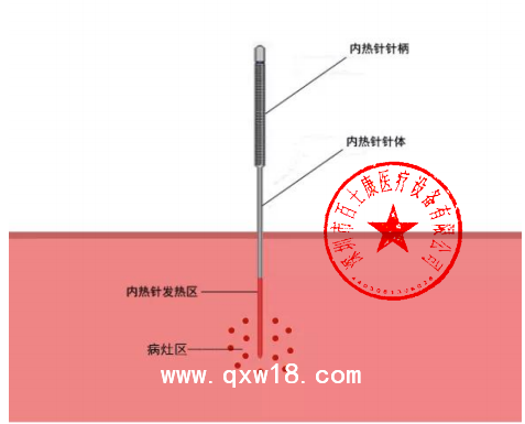 百士康0.7mm*140mm 內(nèi)熱針 內(nèi)熱式針灸針