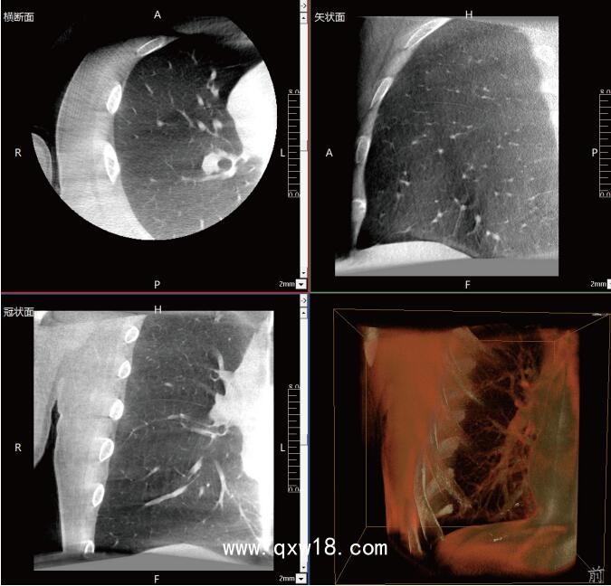 呼吸介入C型臂臨床應用-普愛醫(yī)療三維C型臂CT
