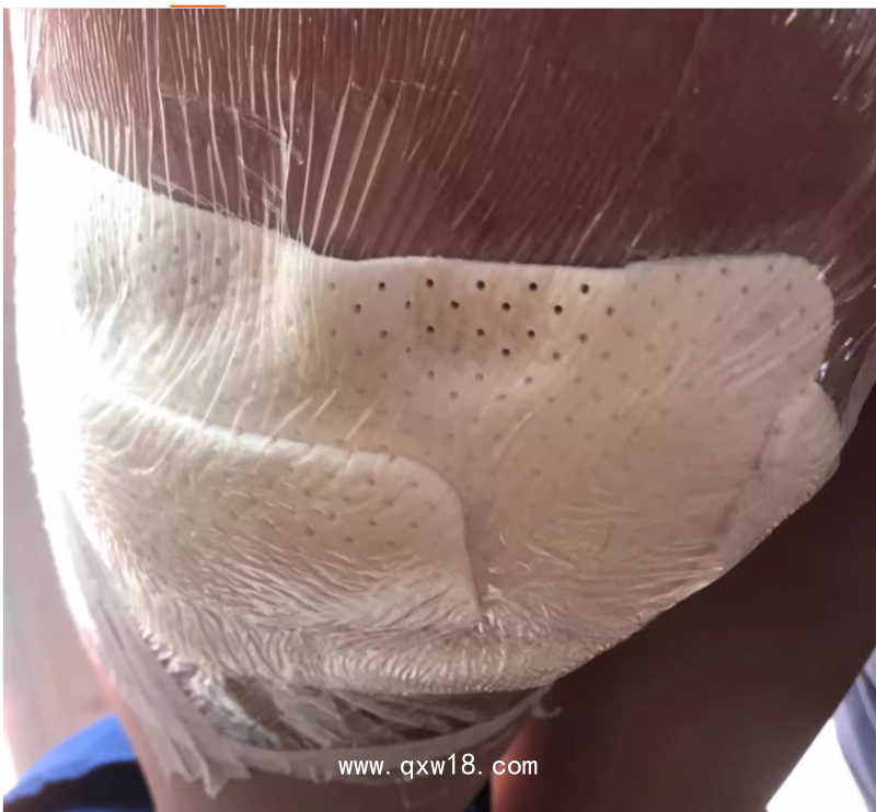 醫(yī)用透明敷貼20x30cm封閉負(fù)壓引流VSD 護(hù)創(chuàng)無菌敷貼膜vsd