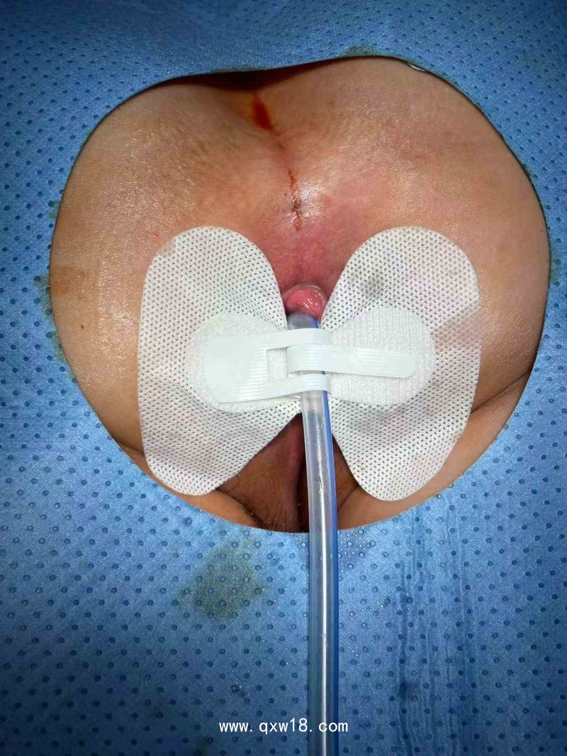 一次性使用肛腸引流管套件