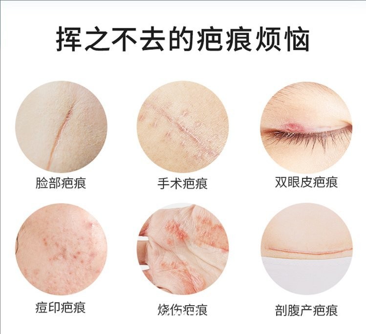 疤痕凝膠/二類(lèi)械字號(hào)醫(yī)用祛疤凝膠/廠里批發(fā)可代加工疤痕凝膠