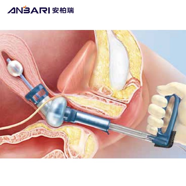 一次性使用擺頭式舉宮器