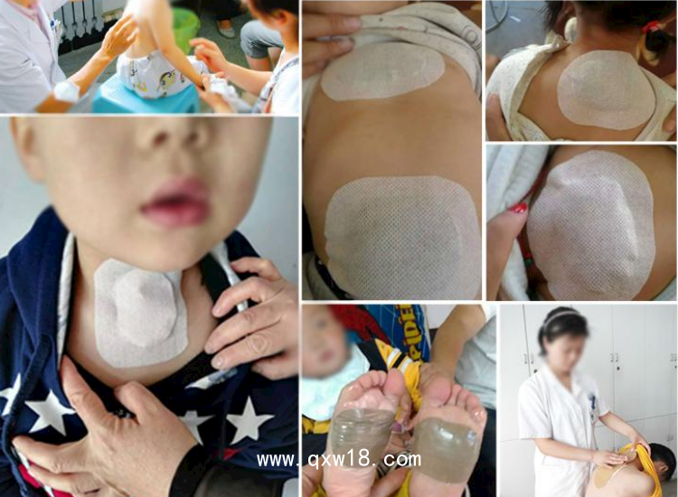 沙蒿子透皮貼含酒精藥水透皮貼膏藥載體二類械字號