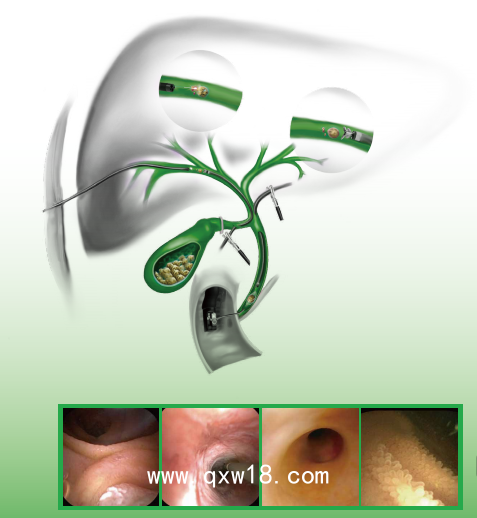 一次性使用電子膽道鏡