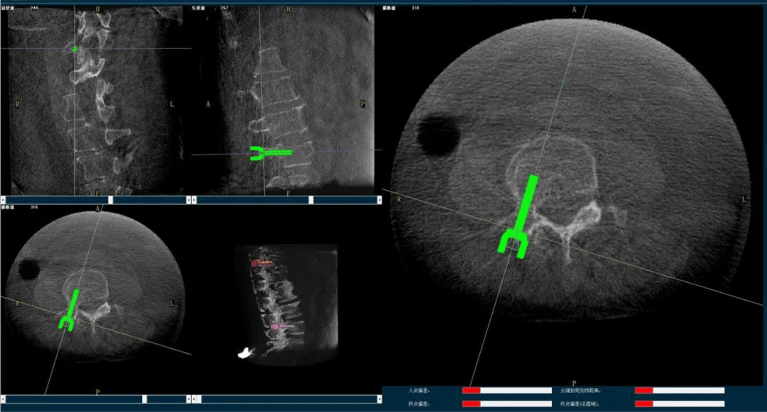 骨科手術(shù)機(jī)器人規(guī)劃圖像