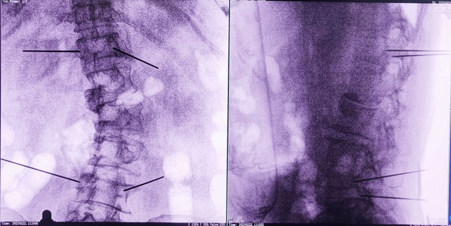 骨科手術(shù)機(jī)器人術(shù)后圖像